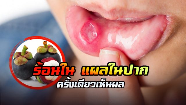nakhon-online แก้ร้อนใน แผลในปาก