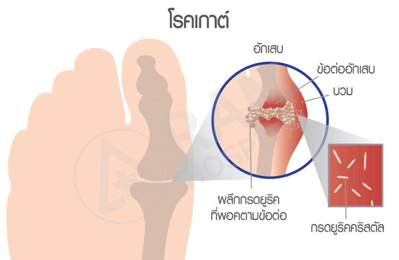 โรคเกาต์