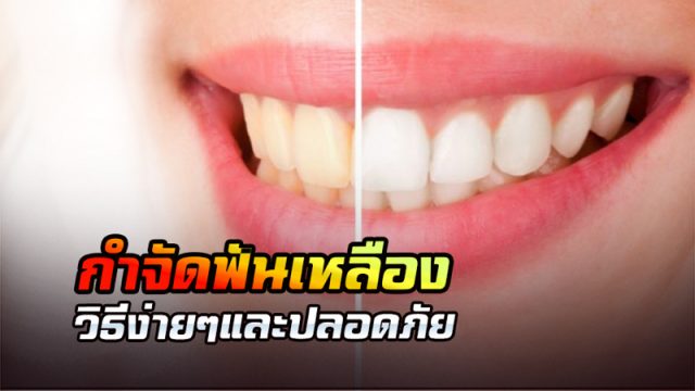 กำจัดฟันเหลือง กำจัดฟันเหลือง