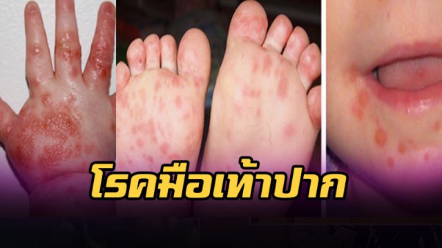 ป่วยโรคมือ เท้า ปาก