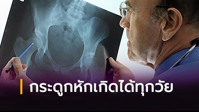 กระดูกหักเกิดได้ทุกวัย กระดูกหักเกิดได้ทุกวัย