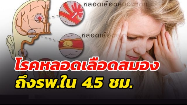 โรคหลอดเลือดสมอง