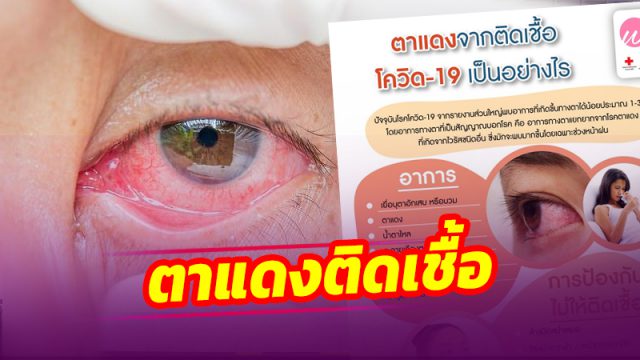อาการ ‘ตาแดง’ แบบไหน ติดเชื้อโควิด19
