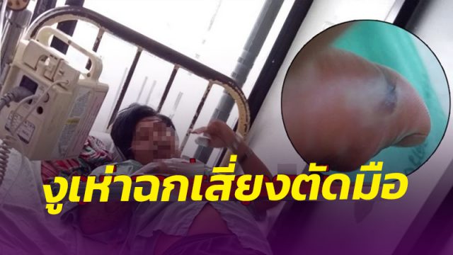 หนุ่มกู้ภัยเมืองคอนถูกงูเห่าฉกอาการรุนแรงขึ้น เผยอาจต้องตัดมือซ้ายทิ้ง